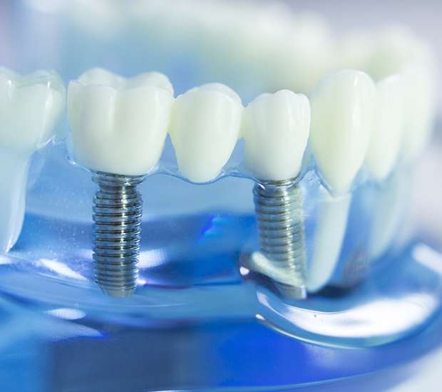 Garden Grove Dental Implants