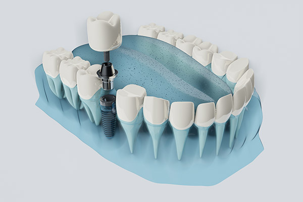 FAQs about Dental Implants from Allstar Dental in Garden Grove, CA