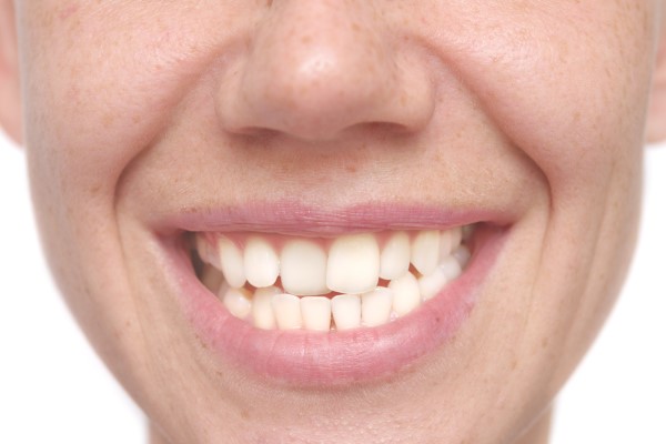 The Complete Guide To Teeth Straightening For Adults